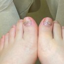 발톱닥터 | 일산내성발톱교정 | 식사동 '발톱닥터' (통증, 교정후기, 효과, 가격)