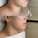 청주 경락마사지 더리파인, 볼살 턱선 고민 브이라인 완성 후기