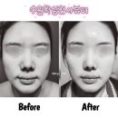 동성미용타운 | 수원윤곽관리 찾는다면? 알테온 효과 제대로 본 내돈내산 후기!!