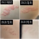 문산중앙병원 | 대상포진 치료후기 (문산중앙병원)