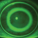 고려대학교안경콘택트 | [연지동 드림렌즈] 드림렌즈 후기: 시력교정 수술을 대신할 수 있을까?