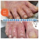 무좀 방치 발톱무좀 +봉와직염 전신염증 고생하다 부천 연세튼튼의원 문제요발관리센터에서 건강을 되찾다.