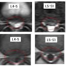 미라이님의 요추디스크 L4-5, L5-S1의 MRI 사진 판독입니다. 이미지