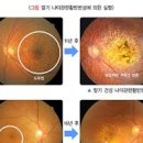 노인성 황반 변성 원인과 증상 건성 습성 주사 치료 이미지