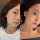 서울 온다리프팅 1회 효과 유지기간 후기 전후비교