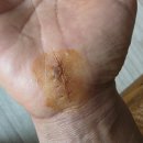 충주 손목터널증후군 수술 후기｜바른몸정형외과에서 국소마취 수술받은 실제 경험