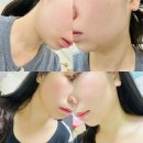 인천 부평 올타이트 이중턱 심부볼 부자의 나솔 순자리프팅 내돈내산 후기
