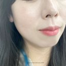 또팔자 | 압구정 피부과 엘란쎄 하트라인 팔자주름 시술 후기