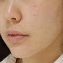 앞볼필러 대신 힐로웨이브 후기 봉은사역 피부과