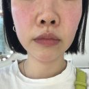 (주)두꺼비재생사업단 | 대구 피부과 추천 온다리프팅 6만줄 7만줄 붓기 비교 후기