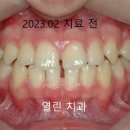 벌어진 앞니 교정치료 후기