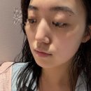 다은메디칼 | 멀티플라즈마 일주일 후기, 모공 삭제 대박! 서울대입구 피부관리 에스테틱다은