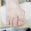 로다샵 | 목포발톱무좀 문제성 잘하는 샵 페디크루 로다풋케어