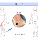 태선 이미지