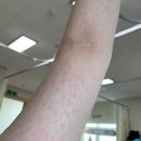 없습니다 | 온몸 두드러기 가려움 더 이상 걱정없습니다 + 후기