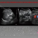 Tortuous Splenic Vein Dilatation in Liver Cirrhosis without Splenomegaly 이미지