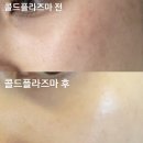 아르나뷰티(Arna beauty) | 성북피부관리 [아르나뷰티] 기미 잡티 콜드플라즈마 관리 후기👍