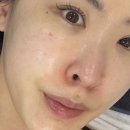 누가광명한의원 | 청담피부관리 안면홍조 여드름 아토피 모공 피부트러블관리 엑소좀 효과 전후비교