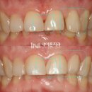 내이튼치과의원 | 벌어지고 튀어나온 앞니, 동탄역 내이튼 치과 에서 교정 없이 개선을 도와드렸던 방법은?!
