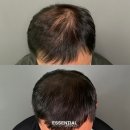 마두도서관 지하(음영지역)2 | 백석 마두 정발산 탈모 커버 SMP, 비수술로 인생 바꾸기