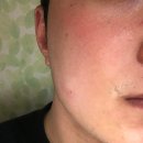 남성상사 | 남성 안면홍조 원인, 홍조크림으로 해결 +후기임