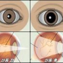 안과 눈 검사 동공 확대 산동제 안약 산동검사 망막 이미지