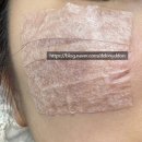 더디자인성형외과의원 | [서울/압구정역] 양측성후천성오타양모반 치료 압구정 라움성형외과의원 후기(예약 방법, 가격,tip 등)