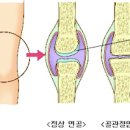 엉덩이가 아파요 고관절 통증 이유 이미지