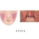 딸기코(Rosacea) 피부질환이란? 이미지