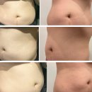 엔디어트의원 | 압구정 지방분해주사 강남다이어트 복부지방 (엔드컷 3회차 후기)