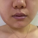 서울마디시원신경과의원 | 신도림 매복사랑니 발치 후기 사랑니 3개 사랑니전문치과 당일 발치 후기