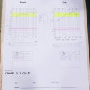 귀먹먹, 귀울림 돌발성난청 증상과 치료후기/10일만에 정상으로