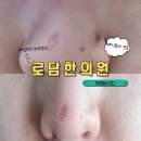패인흉터 치료 전문병원 자신있게 추천하는 [로담한의원] 새살침 솔직후기