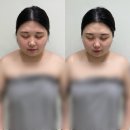 [윤곽관리] 첨단에스테틱, 광주 작은 얼굴 관리 내돈내산 후기 &#39;에스테티아&#39;