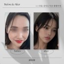 올린 | 신사동 실리프팅으로 얼굴 라인 팽팽하게 올린 후기1:1전문 의료기관 실리프팅