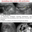 Ascending colon cancer with perforation 이미지