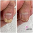 항진상회 | 의정부 임산부 수유부 임신 준비 중 무좀일 때 어떻게 해야 하나 임산부 무좀약 추천