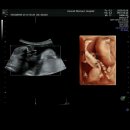 한나산부인과의원 | 임산부 일상 3 ; 임신 20주차 한나여성의원 정밀검사 후기