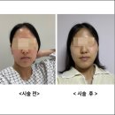 신사역 성형외과 민트실 리프팅 + 필러 솔직후기