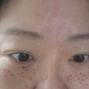 예일의원 | 영통 예일피부과 점 비립종 뺀 후기