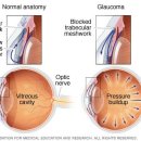 녹내장 이미지