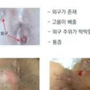 항문튀어나옴 치질만이 원인일까 이미지