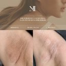 예스다 뷰티앤왁싱 본점 | 부평 색소침착 멜라닌케어 슈가문왁싱에서 받은 팔꿈치 케어 후기
