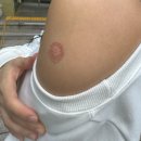 서초구보건소 | 임산부 서초구 보건소 백일해 무료 접종후기(증상과 주의사항)