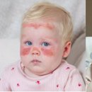 여름철 자외선으로부터 피부를 지키는 법/“흐린 날씨에 선크림 SPF50 발랐는데”…1세 아기 얼굴에 화상, 무슨 일? 이미지