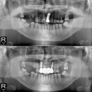 본정치과의원 | 숭의역치과, 위아래 임플란트치료는 한번에 하는게 좋습니다.