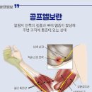 골프엘보 통증 원인 예방법 이미지