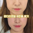 이벤트 - 목포시 차범석길 41 | 부산 서면 온다리프팅 6만줄 이벤트 후기 효과와 통증은?