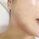 면목동피부관리 더숨에스테틱, 이중턱 관리받고 온 후기