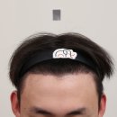 2172 | [대다모 포토후기] 20대 남성 2172모 모발이식 180일 후기입니다.